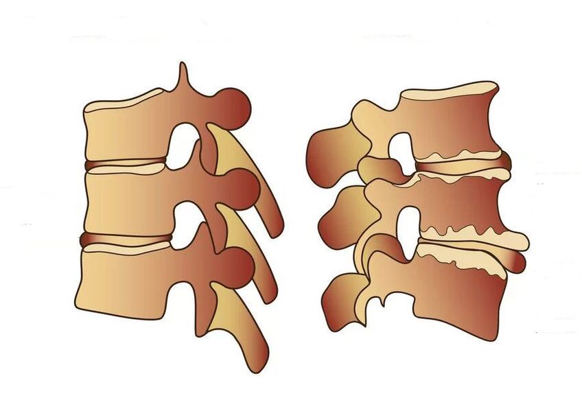 columna vertebral san e enferma