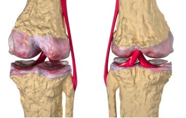 Varices de desenvolvemento de gonartrose