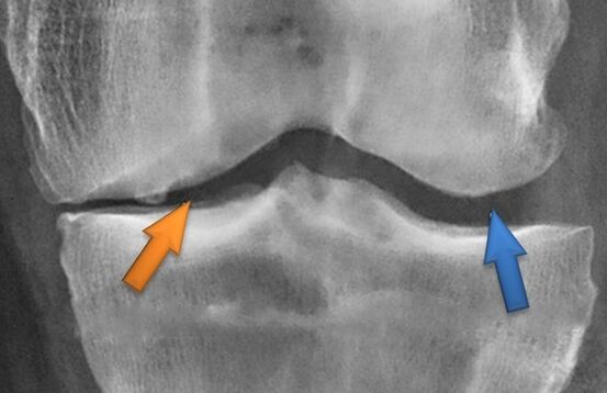 Kineteithetorapie para osteoartrite