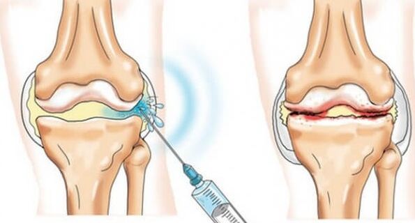 Medidas médicas para a artrose