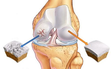 Que é a osteoartrite da articulación do xeonllo
